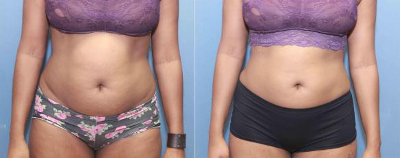 liposuction of stomach