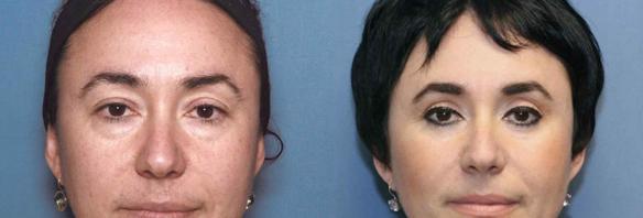 Cosmetic eyelid lift, upper and lower blepharoplasty, facial plastic surgery