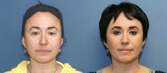 upper eyelid lift, lower eyelid lift, blepharoplasty, cosmetic surgery, Beverly Hills