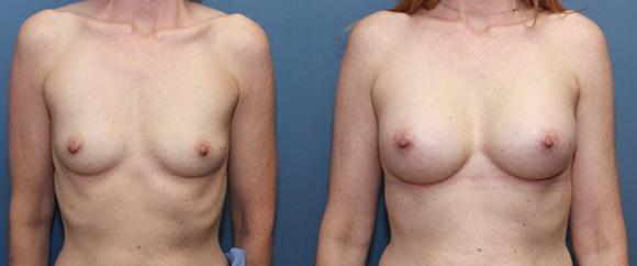 breast implants silicone after pregnancy A/B cup size to a C cup size