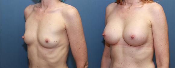 breast implants silicone after pregnancy A/B cup size to a C cup size