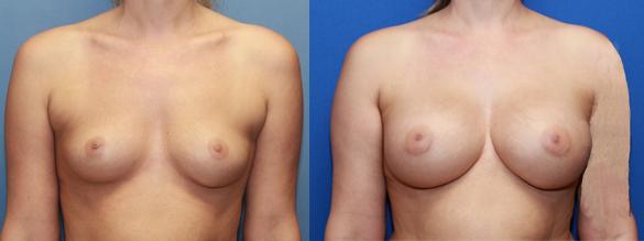 Silicone breast implants augmentation C/D cup size