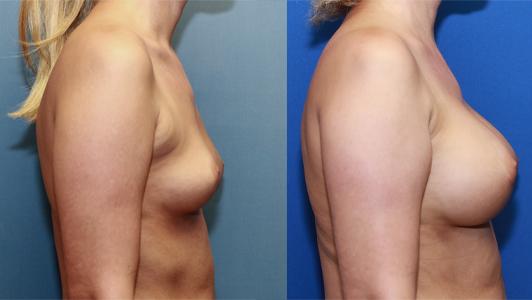 Silicone breast implants augmentation C/D cup size