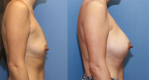 Post pregnancy breast enlargement with silicone gel implants upper C cup size.