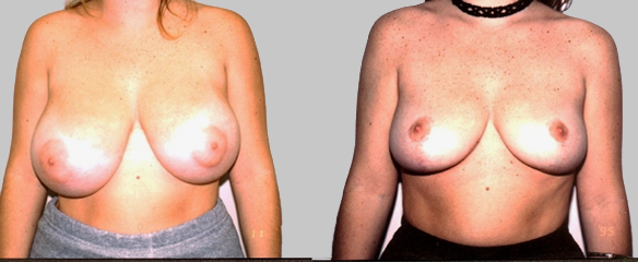 breast reduction, E cup size, DD cup size, C cup 