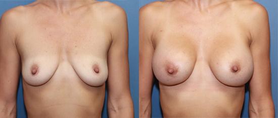 breast enahancement, after pregnancy, emptiness, children