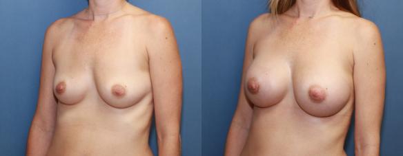 330 cc silicone breast implants, augmentation, mother