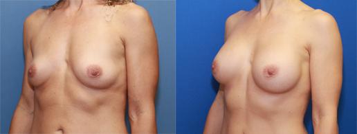transaxillary breast augmentation to a small C cup