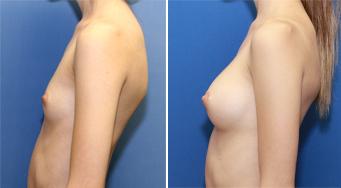 Breast implants A cup to a B cup size 250 cc cohesive silicone