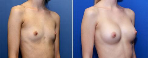 Breast implants A cup to a B cup size 250 cc cohesive silicone