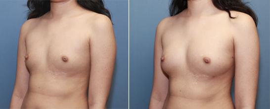 fat transfer, breast augmentation, breast enlargement, B cup