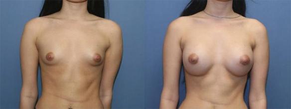 A cup size breast, C cup size breast, silicone breast implant.