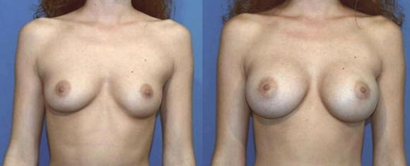 breast enhancement to a C cup size with breast implants Beverly Hills