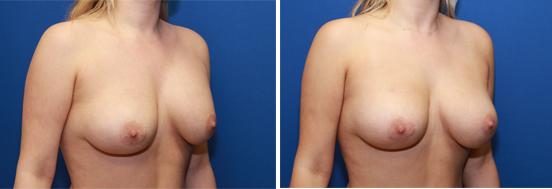 Capsule contracture treatment by capsulectomy and exchange from saline to silicone breast implants.