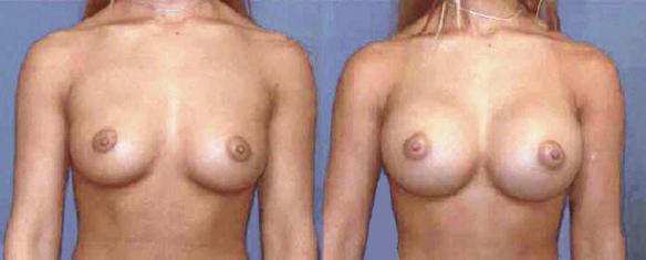 D cup size breast enlargement with breast implants.