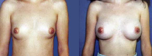 D cup breast enlargement or augmentation using silicone breast implants