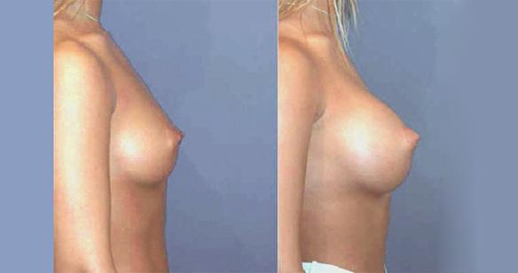 D cup size breast enlargement and augmentation with breast implants.