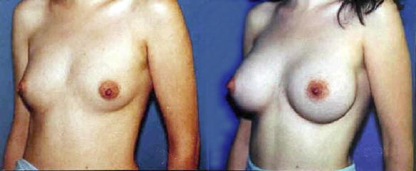 full C cup or D cup size breast enlargement.