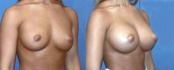 D cup size breast enlargement with silicone breast implants.