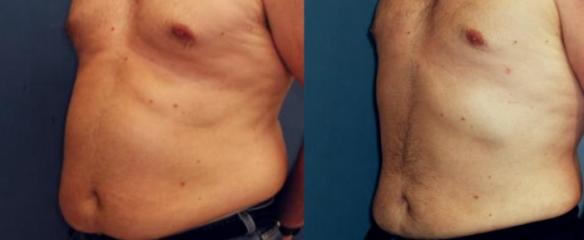 liposuction of male abdomen and chest