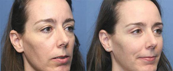 upper eyelid lift and lower eyelid lift plastic surgery