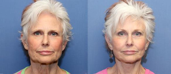 facelift, browlift and necklift plastic surgery with fat grafts