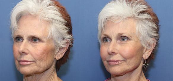 facelift, browlift and necklift plastic surgery with fat grafts