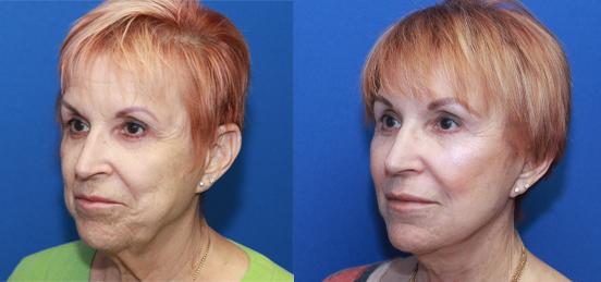 browlift, facelift and necklift with CO2 laser peel of mouth and lower eyelids
