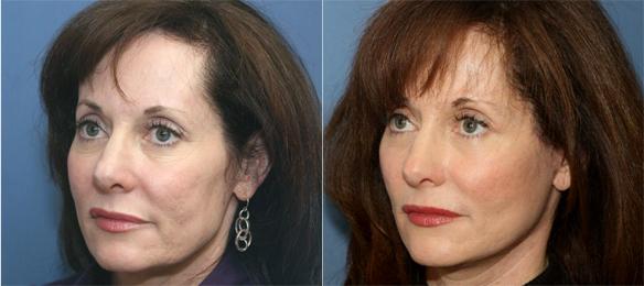 face lift, neck lift and brow lift with fat injections of the face.