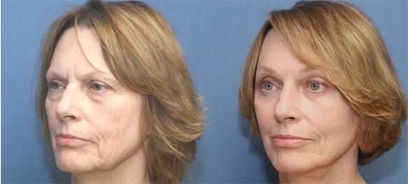 eyelid lift or blepharoplasty with brow and face lifts.