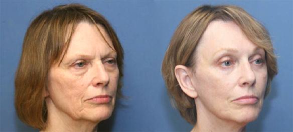 eyelid lift or blepharoplasty with brow and face lifts.
