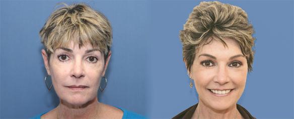 facelift, necklift and laser face peel Beverly Hills Los Angeles