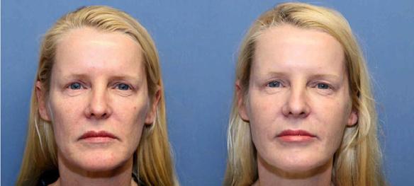 filler injections to the face Juvederm or Restylane