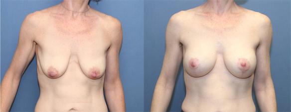 breast lift full with small breast implants