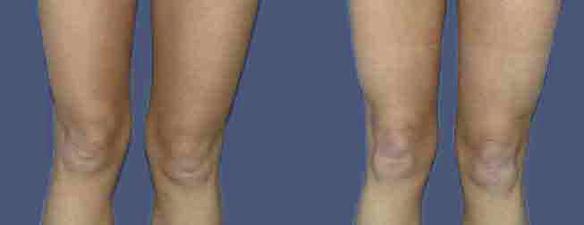 liposuction and body sculpting thighs and knees Los Angeles