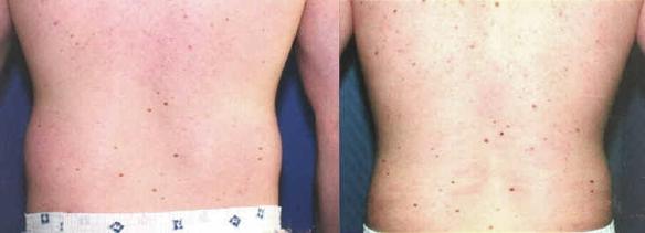 liposuction of trunk or hip rolls male