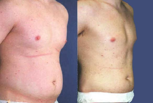 liposuction stomach and male chest liposuction