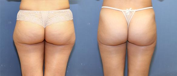 liposuction of hips and thighs in Beverly HIlls