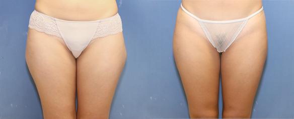 liposculting of hips and thighs in Bevelry Hills