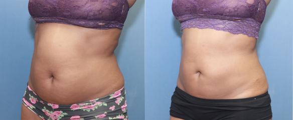 liposuction of trunk.