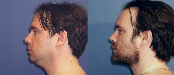 Neck liposuction and fat excision, buccal fat pad, chin implant, fat injection to cheeks.
