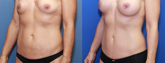 Mommy makeover with mini tummy tuck and breast enlargement