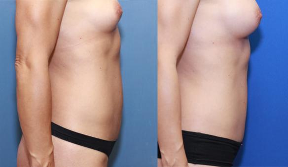Mommy Makover with mini Tummy Tuck and Breast Augmentation
