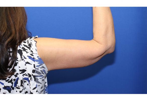 Arm lift or Brachioplasty following weight loss