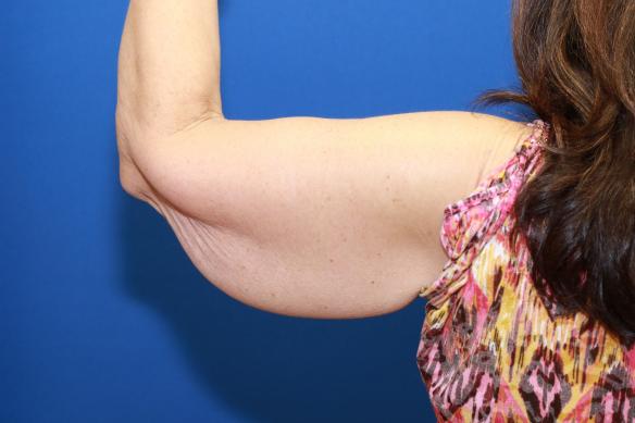 Arm Reduction following weight loss