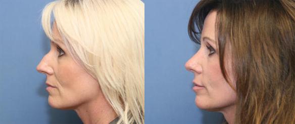 cosmetic nose surgery or rhinoplasty