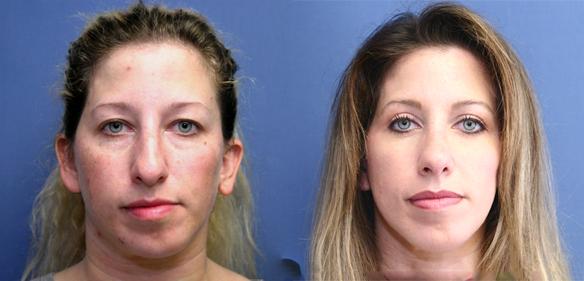Rhinoplasty, cosmetic surgery, plastic surgery, Beverly Hills