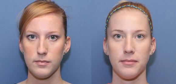 Cosmetic rhinoplasty or nosejob, female, Beverly Hills
