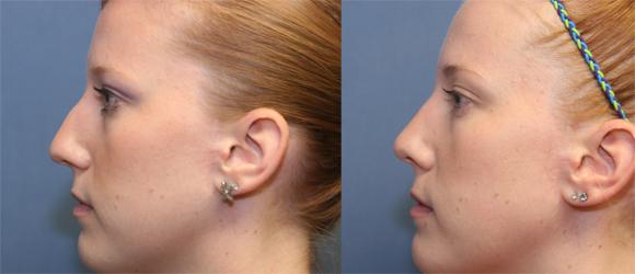 Cosmetic rhinoplasty or nosejob, female, Beverly Hills