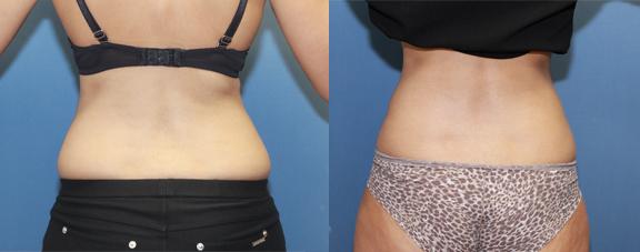 liposuction of the hip rolls or "grab handles."
